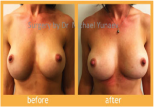 Breast Surgery For Symmetry, What You Should Know