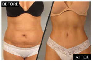 Myths And Facts About Fat Removing Procedures
