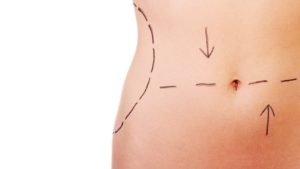 Differences Between A Tummy Tuck Procedure And Liposuction