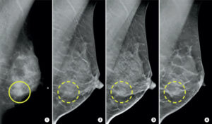 Screening Mammogram