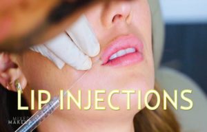 Get Safe Lip Injections at Botox Washington D.C. Clinics