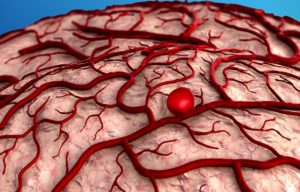 An Overview of Brain Aneurysms with Dr. Mark Swaim MD PhD