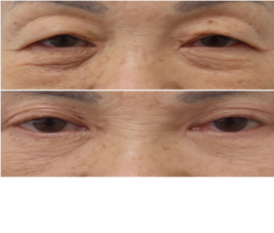 Consider Eyelid Surgery For A Youthful Appearance