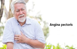 angina pectoris and Types of angina pectoris
