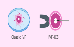 Egg Retrieval and ICSI