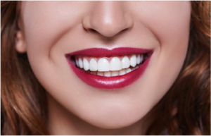 Porcelain Dental Veneers Better