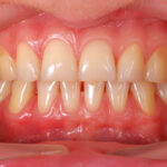 Itchiness in The Gums