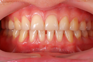 Itchiness in The Gums